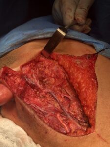 Right superficial parotidectomy