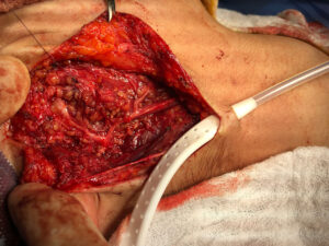 Superficial right parotidectomy