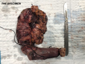 Whipple’s pancreaticodoudenectomy for ampullary carcinoma