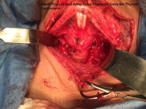 Total Thyroidectomy and LN dissection for Thyroid CA