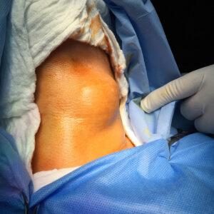 Total Thyroidectomy for Ectopic Thyroid