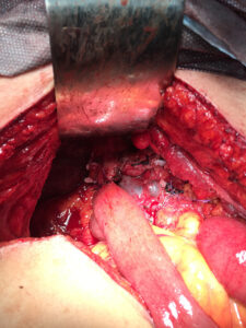 Total pancreaticodoudenectomy plus splenectomy for congenital polycystic pancreas