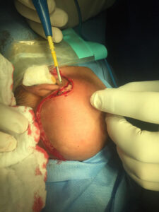 Total parotidectomy for large parotid lipoma in one year old male infant