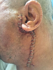 Total parotidectomy for recurrent parotid tumor