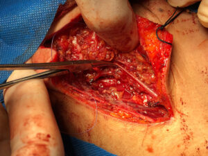 Total right parotidectomy for deep lobe adenoma with symptomatic facial nerve compression