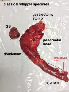 classical Whipple’s for pancreatic adenocarcinoma