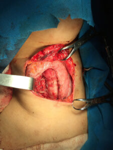 Total thyroidectomy and lymph node dissection for thyroid carcinoma in young adult female