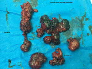 Total thyroidectomy and lymph node dissection for papillary thyroid carcinoma in young male patient