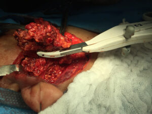 Superficial parotidectomy for Mikulicz disease