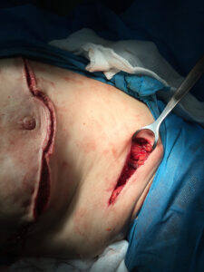 Breast conserving surgery Batwing flap