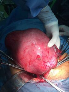 Huge uterine myoma