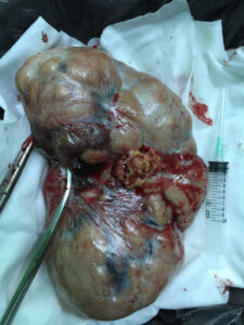 large ovarian mass