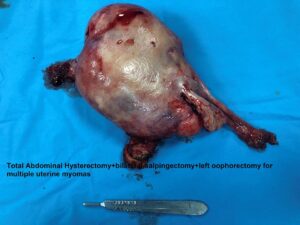 Large and multiple uterine fibroids