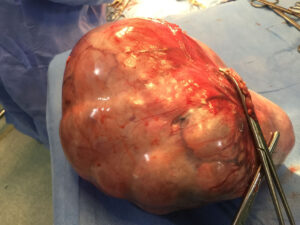 Large ovarian dermoid