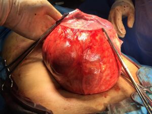 Large single uterine myoma