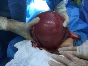 Large uterine myoma (myomectomy)