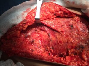 Mastectomy case 4