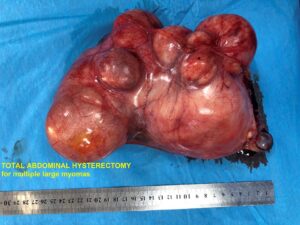 Multiple Uterine Myomas