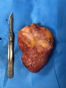 PHYLLOID TUMOR OF THE BREAST