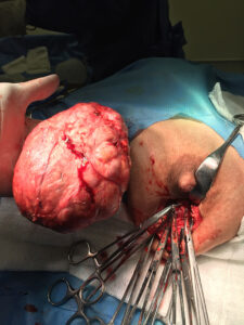 Giant fibroadenoma