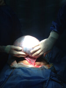 large ovarian cyst