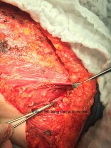 Mastectomy-case 1